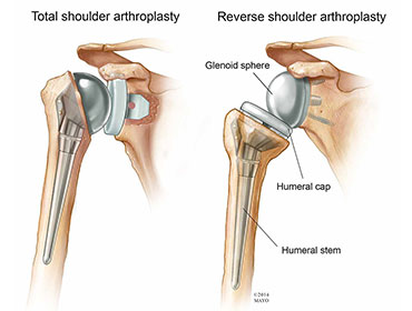 shoulder replacement in chennai