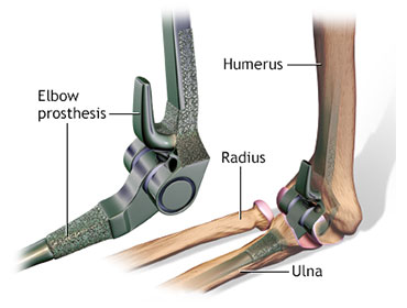 elbow replacement in chennai