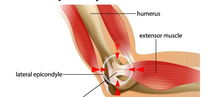 what-are-the-causes-for-tennis-elbow