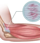 what-happens-if-the-tennis-elbow-is-left-untreated