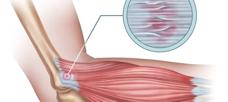 what-happens-if-the-tennis-elbow-is-left-untreated