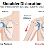 shoulder-dislocation-cause