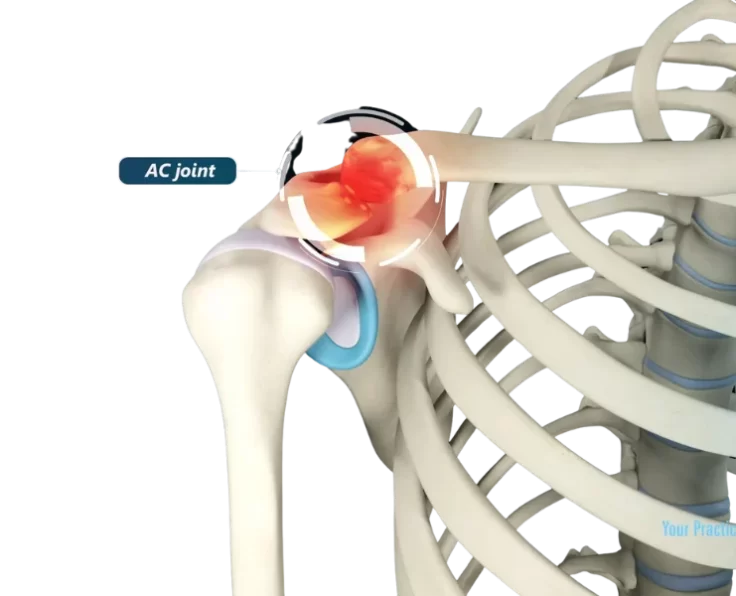 ac-joint-excision -mumford-procedure
