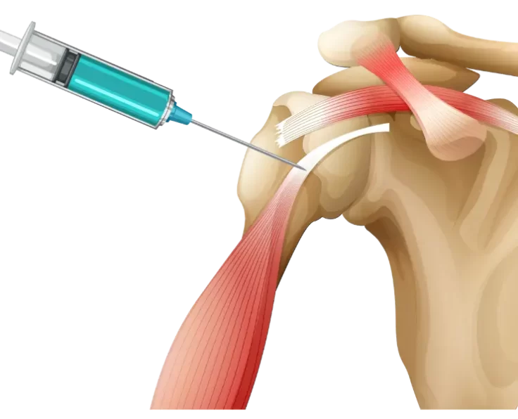 arthroscopic-biceps-tenodesis