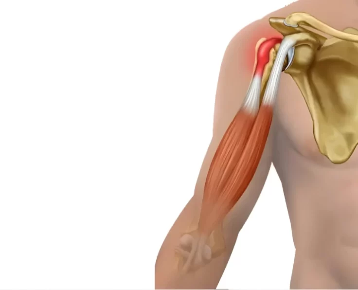 biceps-tendinitis