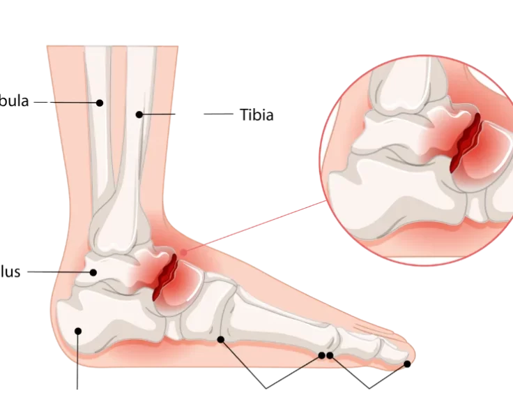 capitellum-fractures