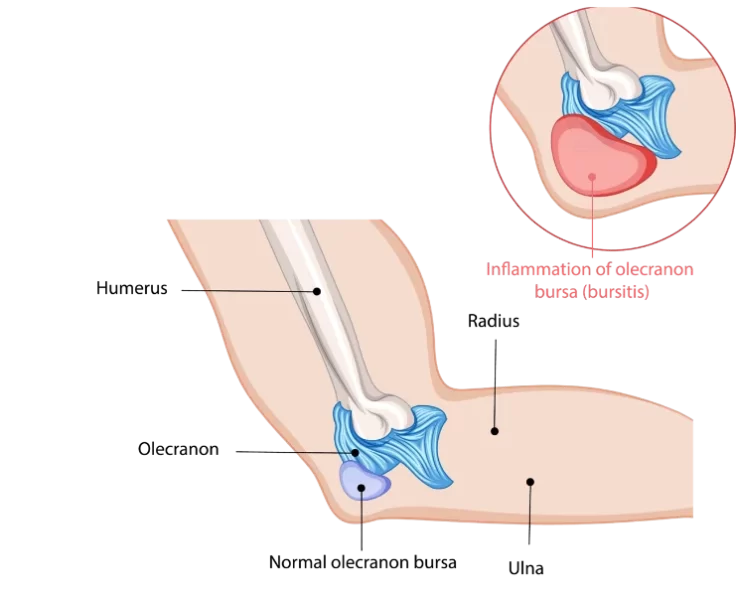 complex-distal-humeral-fracture