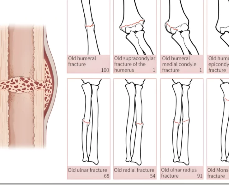 complex-upper-limb-fractures