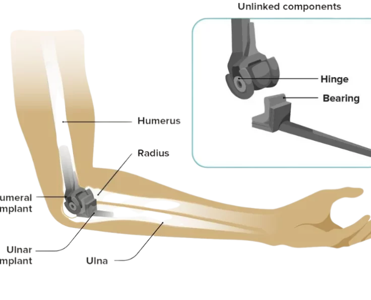 elbow-arthroscopic-capsular-release