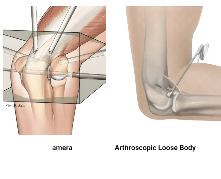 elbow-arthroscopic-removal-of-loose-bodies