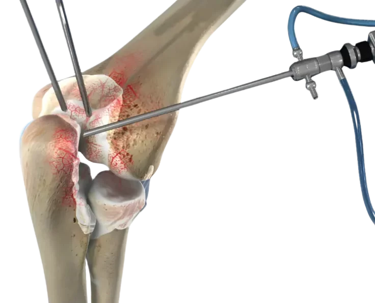 elbow-arthroscopy