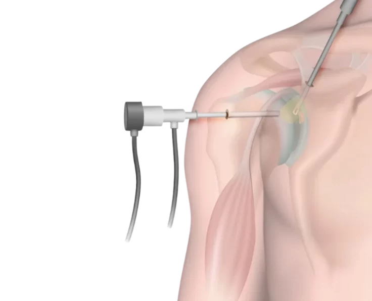 labral-cyst-decompression-and-repair