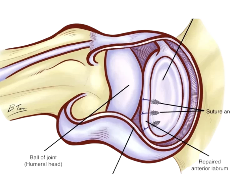 posterior-labral-repair