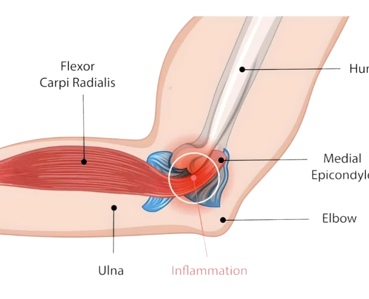 prime-golfers-elbow