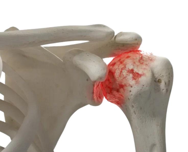 prime-shoulder-arthritis