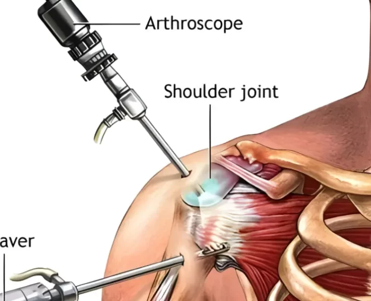 prime-shoulder-arthroscopy