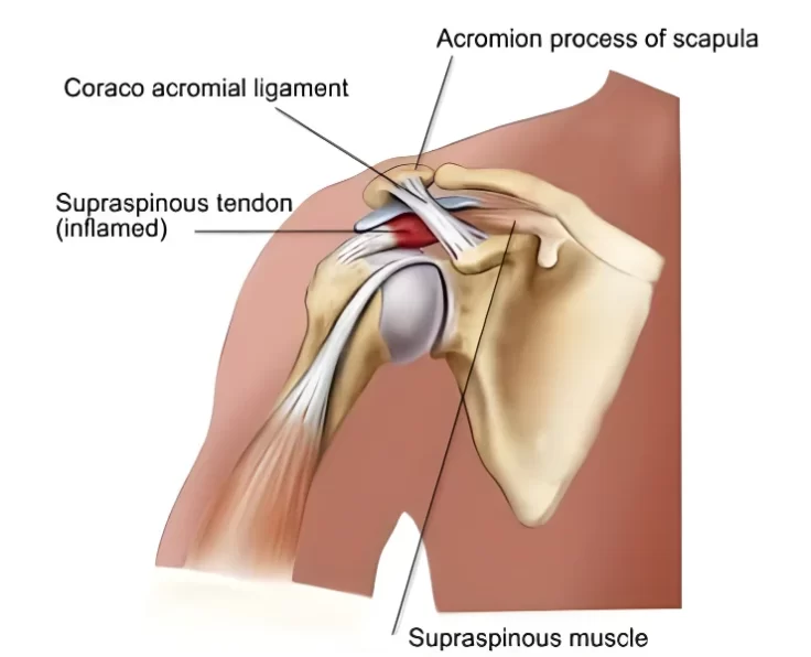 prime-shoulder-impingement-subacromial-bursitis