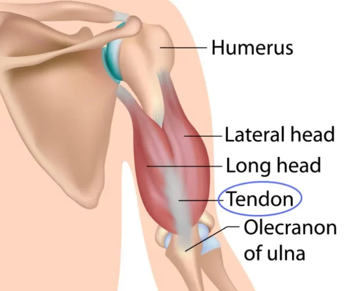 prime-triceps-tendinitis