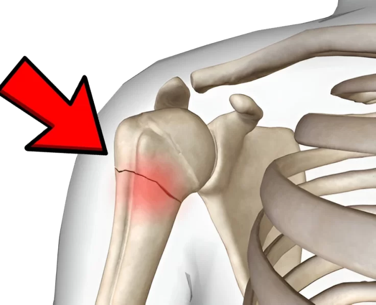 proximal-humerus-fractures