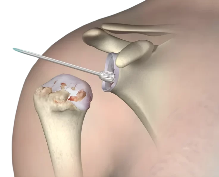 resurfacing-of-shoulder