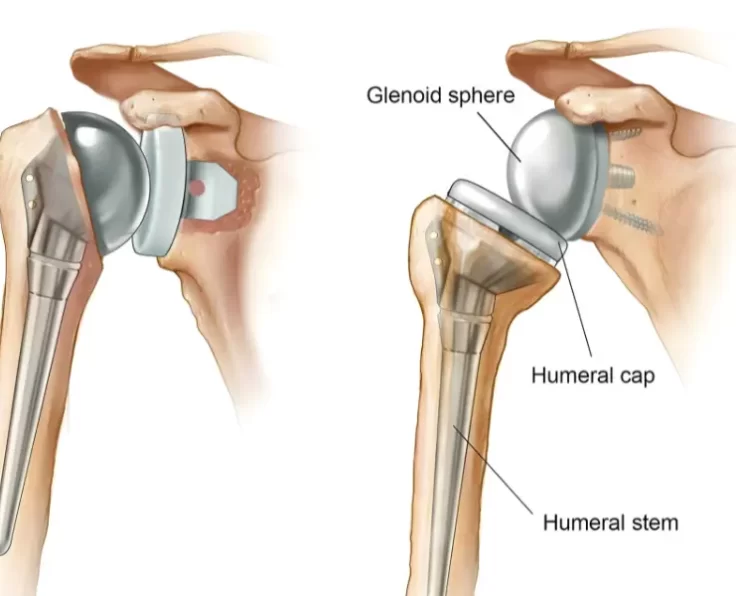 reverse-shoulder-replacement
