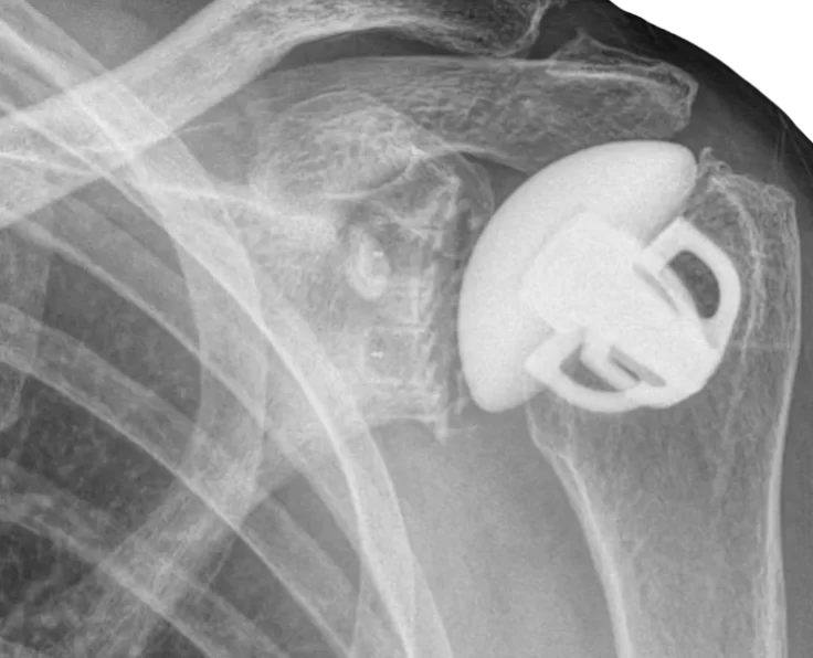 short-stem-shoulder-replacement