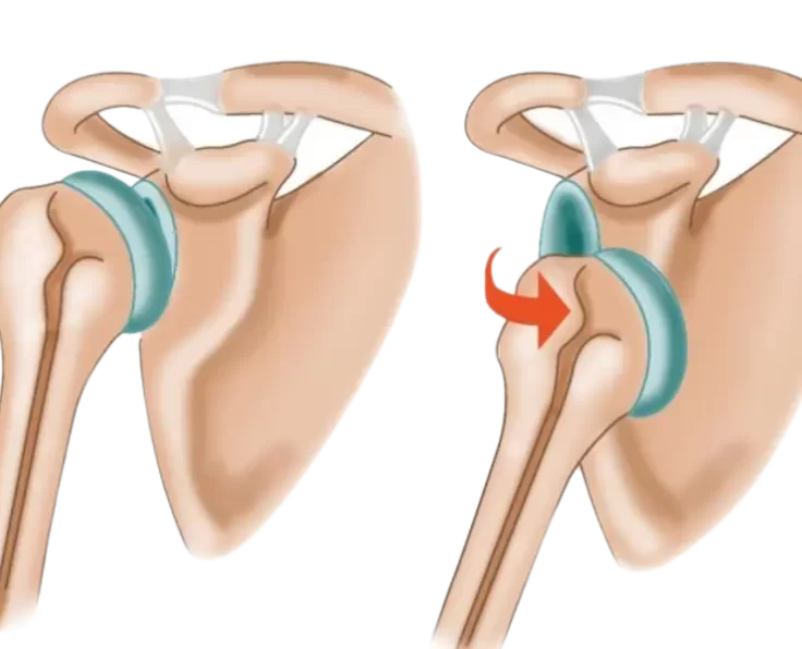 shoulder-dislocation