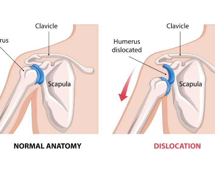 shoulder-fracture-dislocation