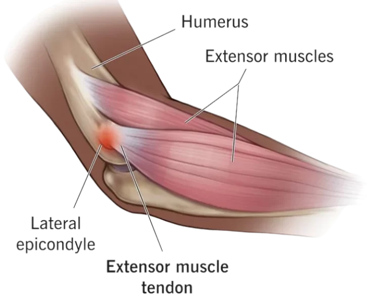 tennis-elbow-release
