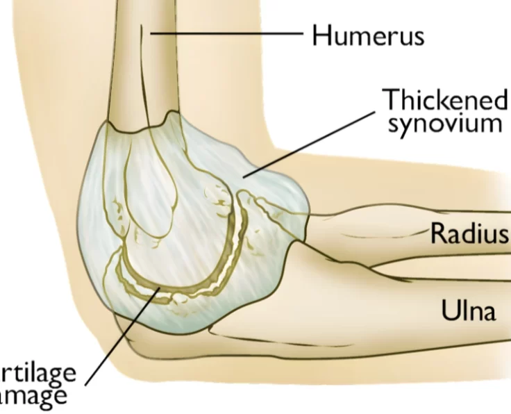 total-elbow-replacement
