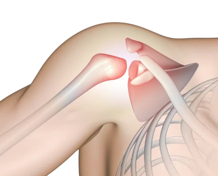 total-shoulder-replacement