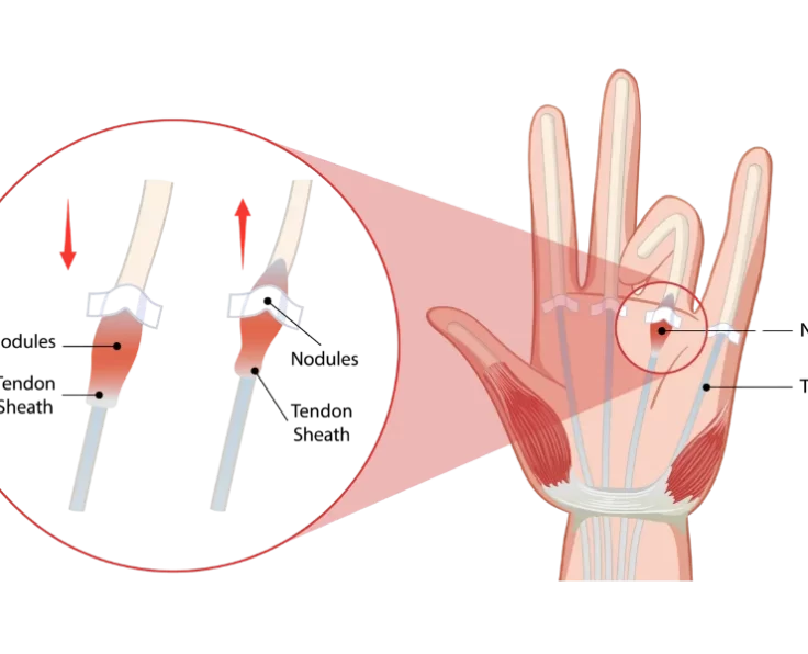 trigger-finger-release